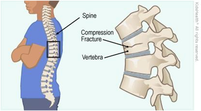 Title: Expert Physiotherapy for Vertebral Compression Fractures in Faridabad