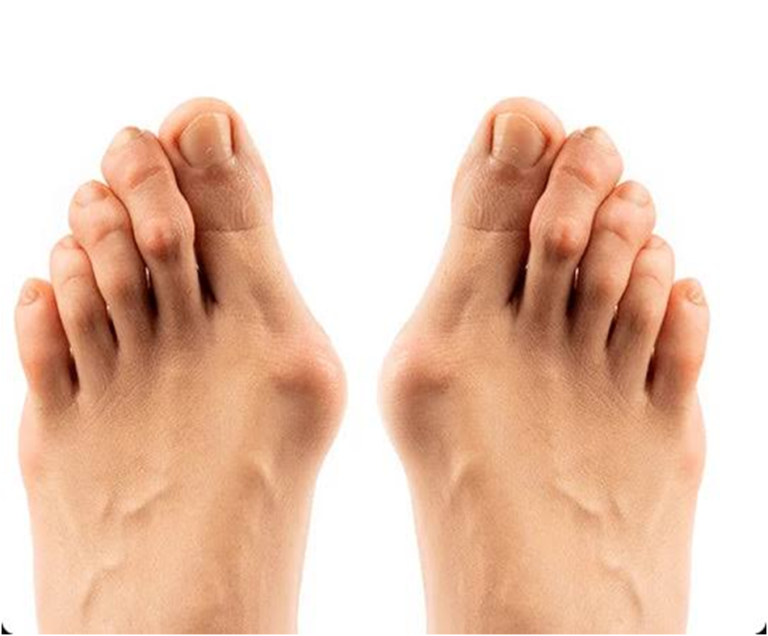 Title: Enhancing Foot Health: Home Physiotherapy for Bunions in Faridabad