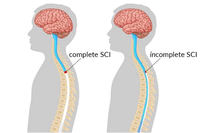Title: Comprehensive Care for Incomplete Spinal Cord Injury