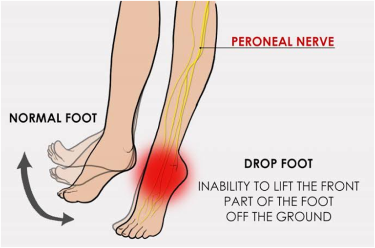 Title: Effective Non-Surgical Treatments for Foot Drop